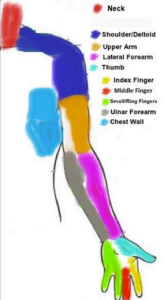 OBSERVED PATTERNS OF CERVICAL RADICULOPATHY HOW OFTEN DO THEY DIFFER FROM A STANDARD NETTER DIAGRAM DISTRIBUTION