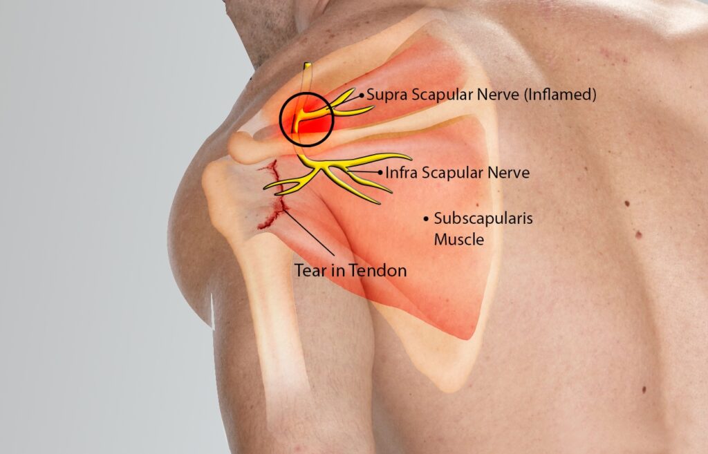 Suprascapular Nerve Entrapment Bangalore Shoulder Institute