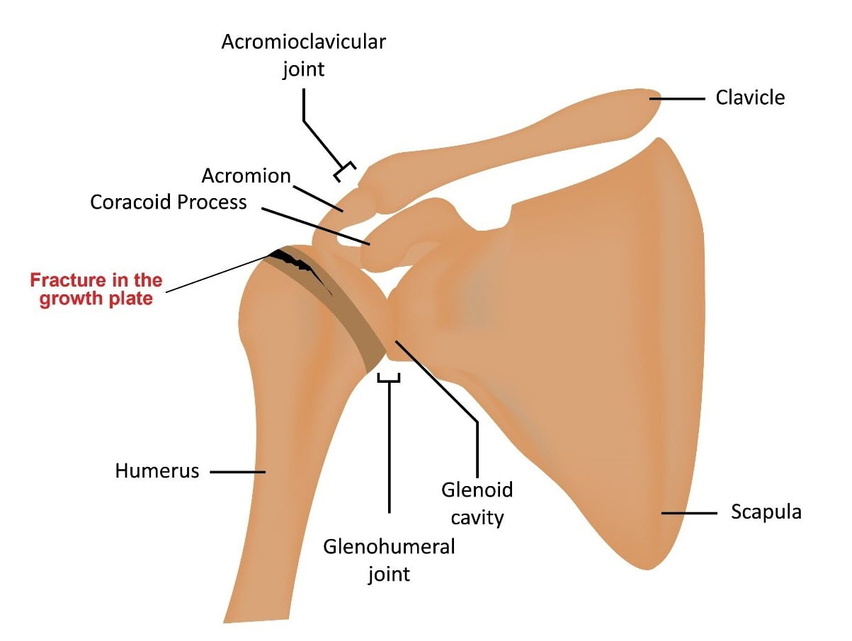 Upper Extremity Fasciitis Examples Dermatomes Chart And Map