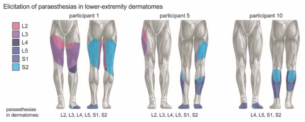 Brain Sciences Free Full Text Transcutaneous Spinal Cord Stimulation Enhances Walking Performance And Reduces Spasticity In Individuals With Multiple Sclerosis