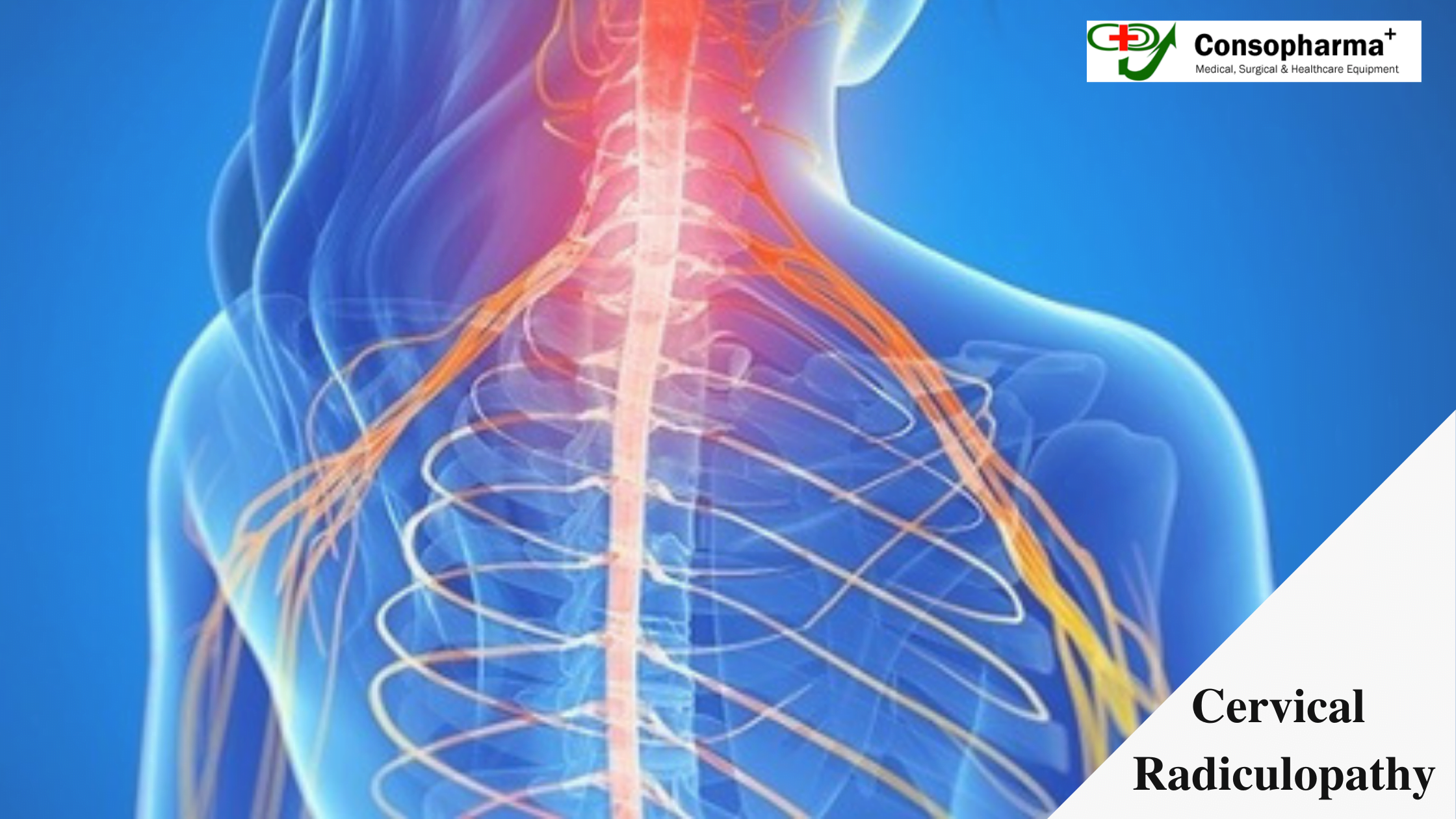 cervical-radiculopathy-symptoms-and-causes-radiculopathy-cervical-my