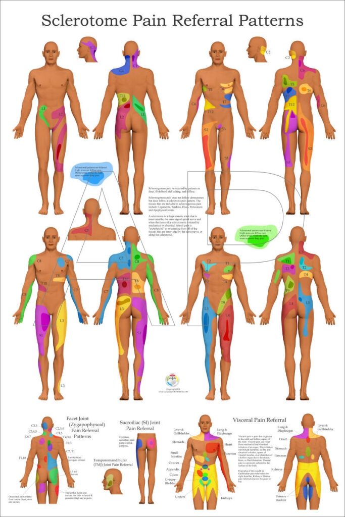 Dermatomal Referral Patterns