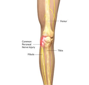 Common Peroneal Nerve Palsy And Physiotherapy Treatment