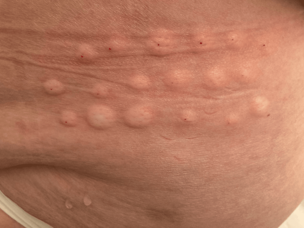 Dermatomal Skin Rash After Lumbar Epidural Steroid Injection