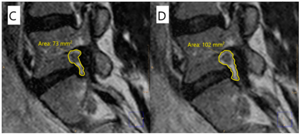 Lumbar Root Dermatome And Mri Correlations