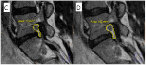 Diagnostics Free Full Text Associations Between Patient Report Of Pain And Intervertebral Foramina Changes Visible On Axial Loaded Lumbar Magnetic Resonance Imaging