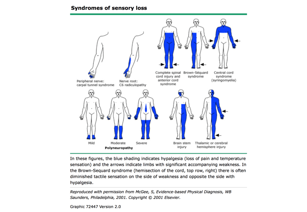 Dermatomal Pattern Of Sensory Loss - Dermatomes Chart and Map