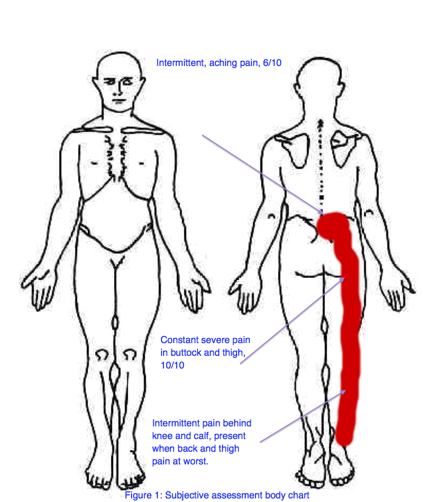 Dermatomal Distribution For Lumbar Disk Problem