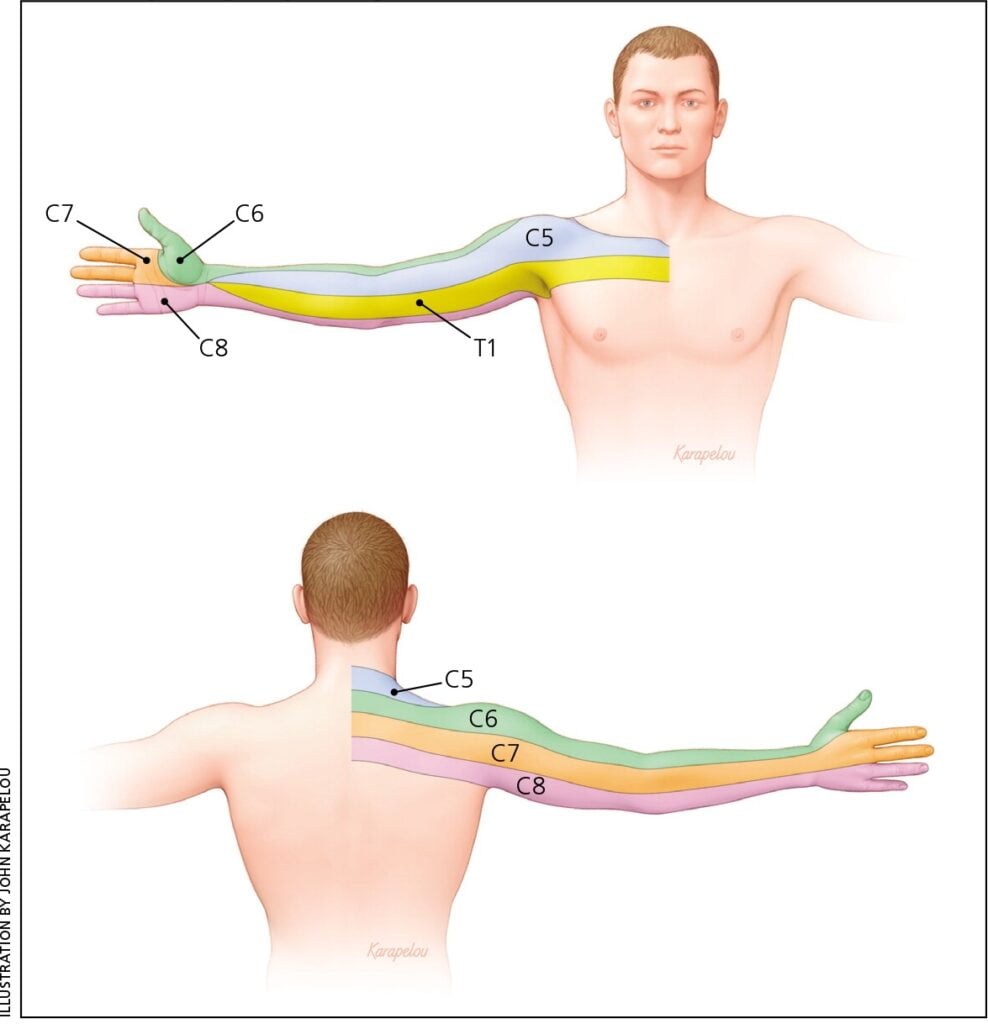 C5 Nerve Root Dermatome - Dermatomes Chart and Map