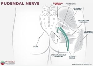 Pudendal Neuralgia Treatment Symptoms WHRIA