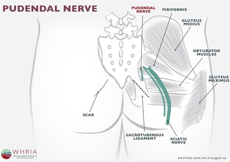 Pudendal Neuralgia Treatment Symptoms Whria Dermatomes Chart And Map 