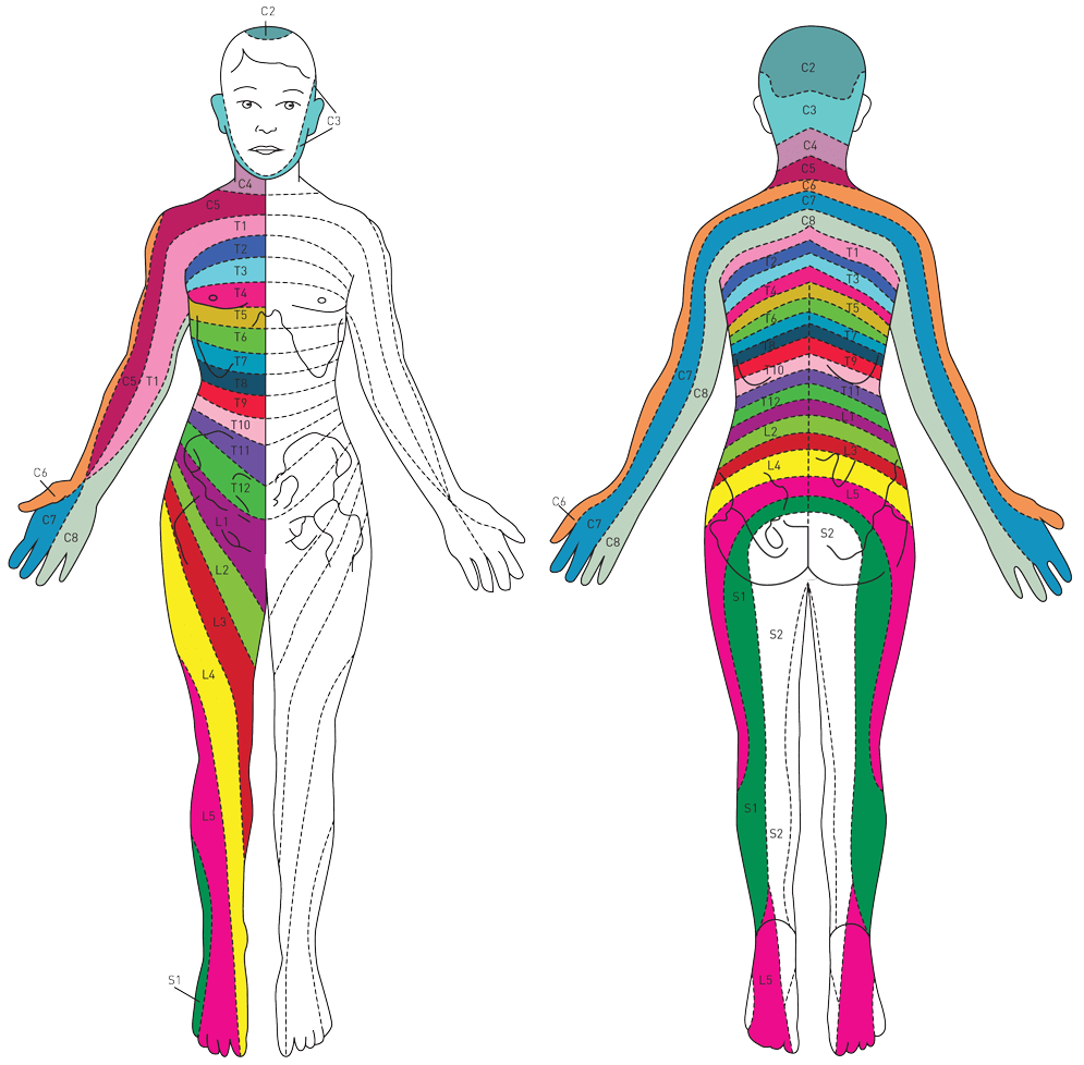 Radiculitis Radicular Pain Causes Symptoms Treatment Dermatomes Chart And Map