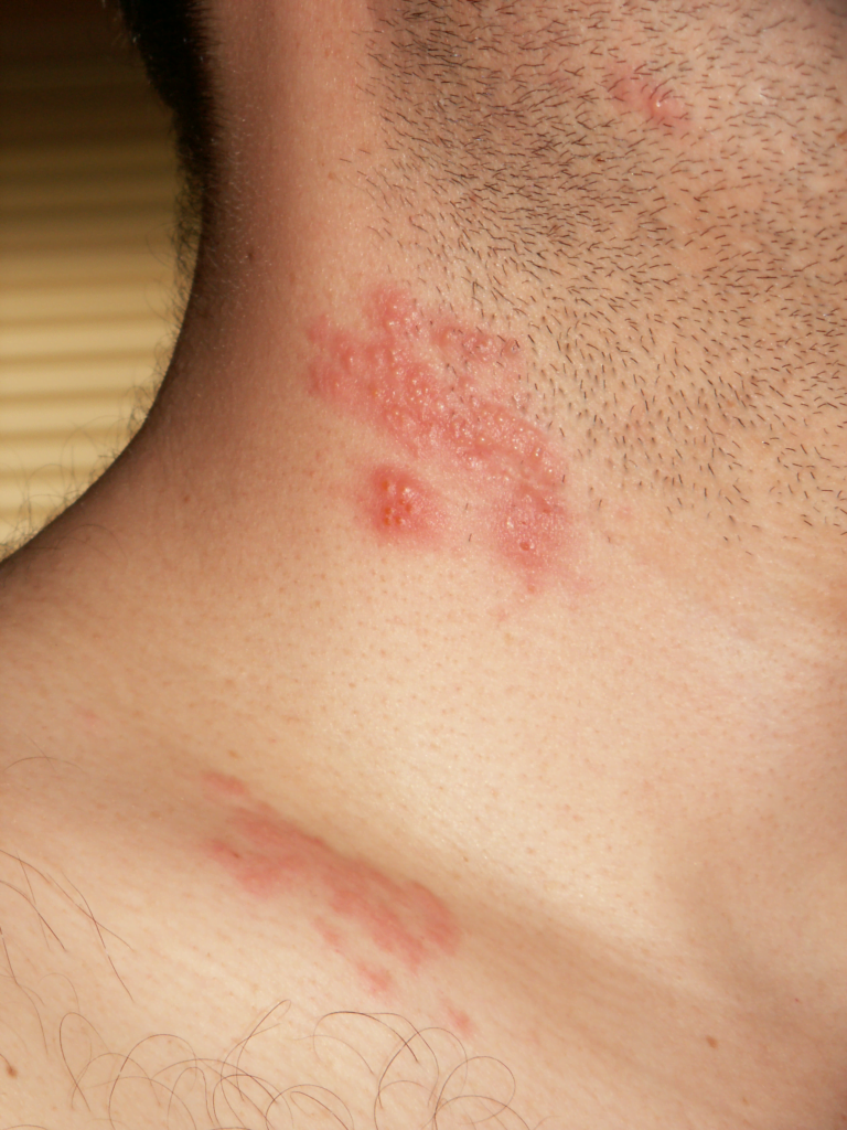 Herpes Zoster Cervical Dermatomes