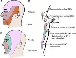 Teaching NeuroImages Onion skin Pattern Facial Sensory Loss Neurology