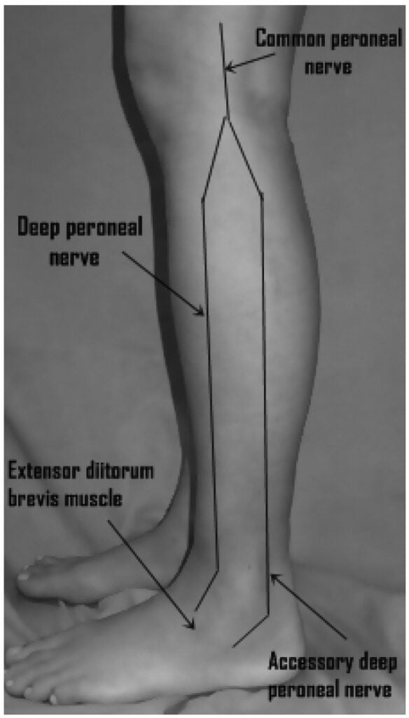 Accessory Deep Peroneal Nerve Dermatome