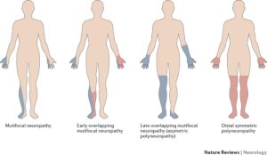 The Nonsystemic Vasculitic Neuropathies Nature Reviews Neurology