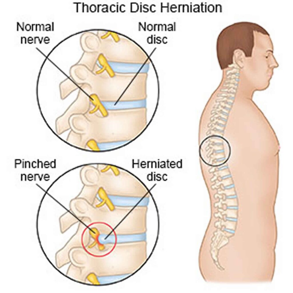 Dermatome Thoracic Bulging Disc 6