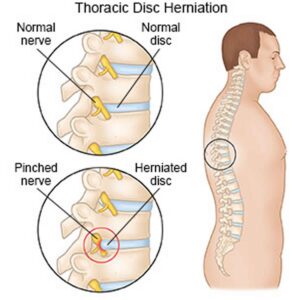 Thoracic Disc Herniation Causes Symptoms Diagnosis Treatment Prognosis